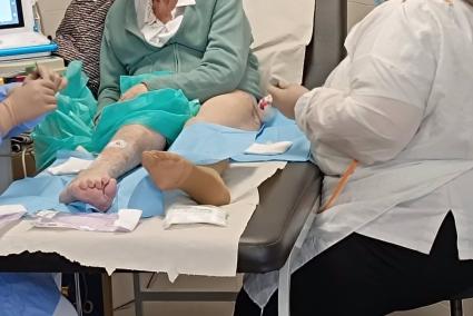 Microinjerto de piel para tratar una herida crónica.
