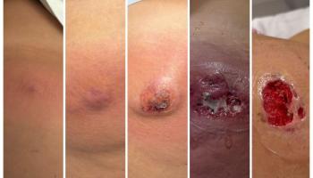 La evolución de la picadura que sufrió la joven en un periodo de cinco días.