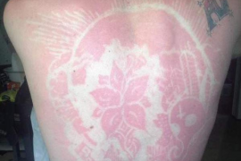 Sunburn Art