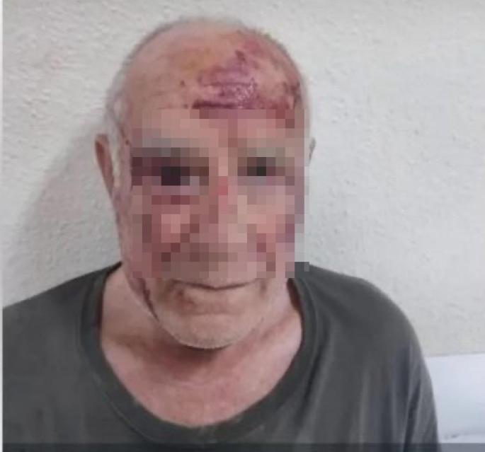 La cara destrozada de un anciano tras una brutal paliza en Torre Pacheco conmociona a Murcia